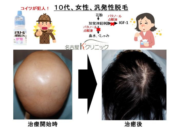 円形脱毛症　病院